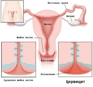 як лікувати цервіцит у чоловіків