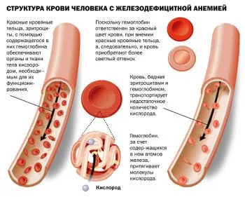 як вилікувати анемію без ліків