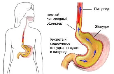 Печія у дітей - герб у дітей - опис, діагностика, лікування хвороб і розладів ніж лікувати печію у дітей
