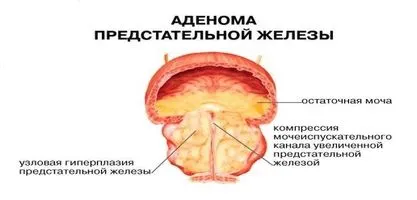 нове в лікуванні раку простати