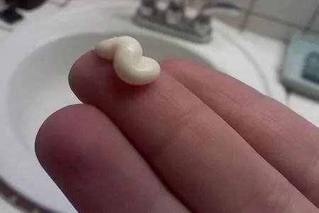 вилікувати геморой без операції