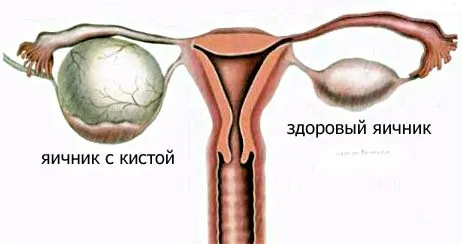 як лікувати кісту без операції