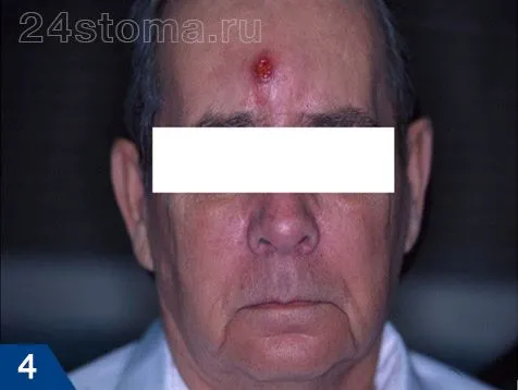 фронтит симптоми лікування