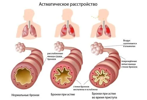 бронхіальна астма лікування