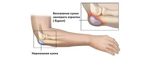 бурсит ліктьового суглоба