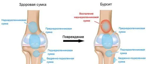 Бурсит: що це, причини, симптоми, діагностика та лікування як лікувати гострий бурсит