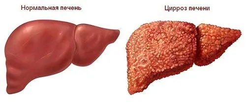 як лікувати кісту на печінці