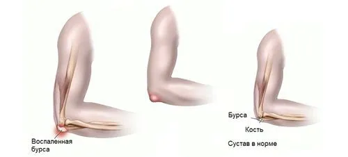 бурсит ліктьового суглоба