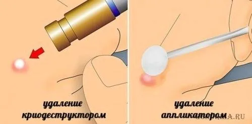 як видалити папіломи