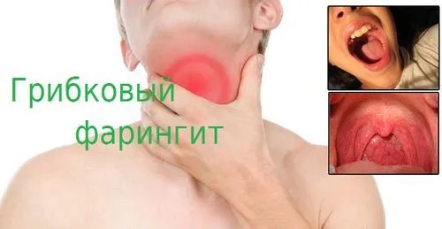 грибковий фарингіт