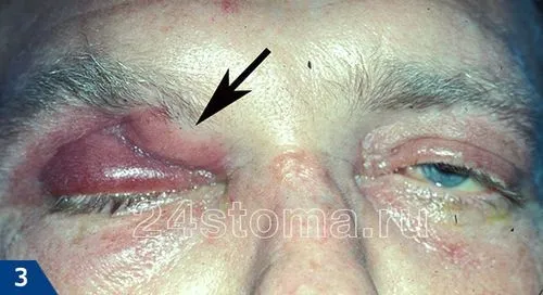 як лікувати фронтит в домашніх умовах