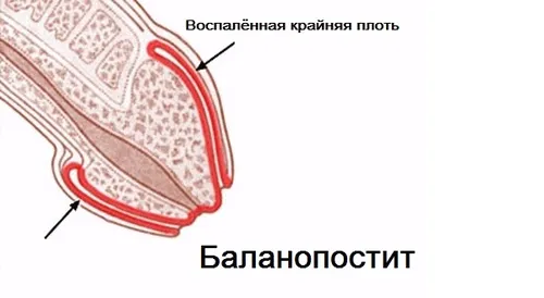 Баланопостит: симптоми, причини, лікування як лікувати баланопостит