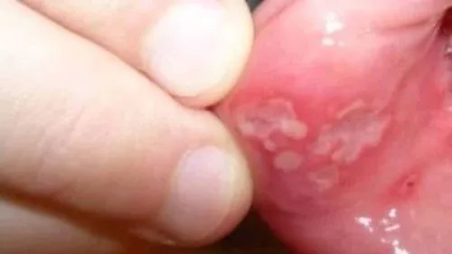 як лікувати афтознийстоматит у дитини 2 роки