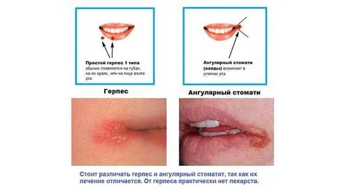 як лікувати заїди в куточках рота швидко