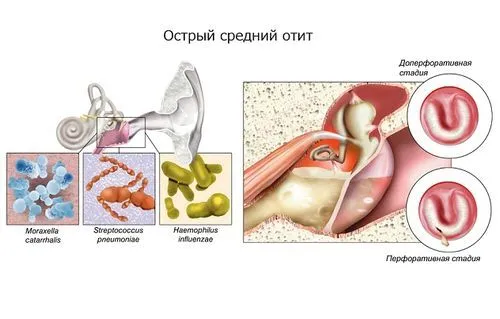 як швидко вилікувати отит будинку