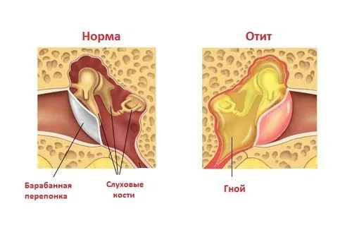 як швидко вилікувати отит будинку