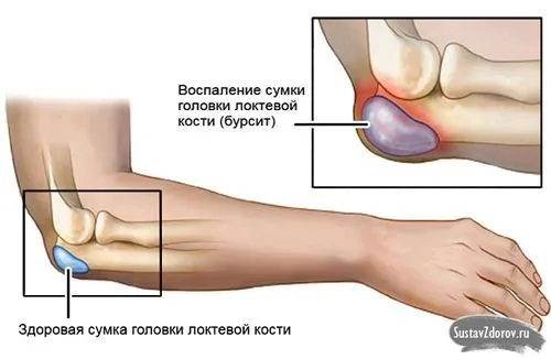 Бурсит: що це, причини, симптоми, діагностика та лікування як лікувати гострий бурсит