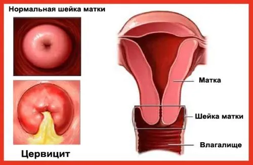 як лікувати цервіцит у чоловіків