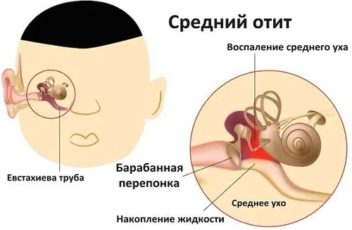 як швидко вилікувати отит будинку