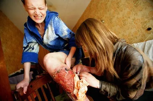 Життя наркоманів як лікувати вени наркомана