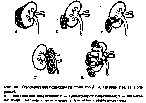 як лікувати відбиті нирки
