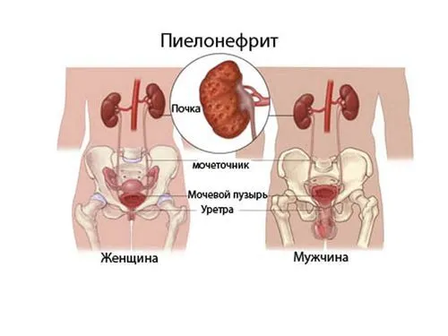 як лікувати нирки якщо застудив