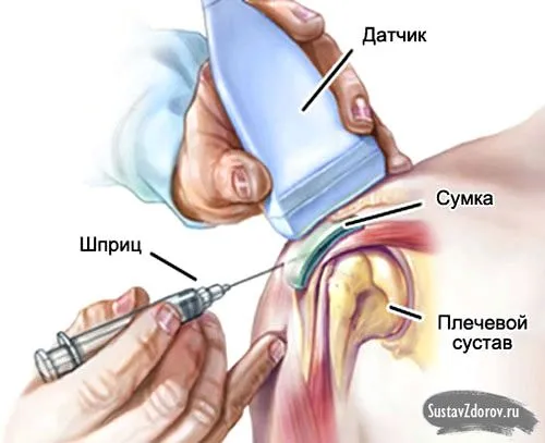 Бурсит: що це, причини, симптоми, діагностика та лікування як лікувати гострий бурсит