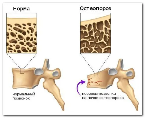 як правильно лікувати остеопороз