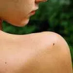 Себорея тіла і її лікування як лікувати себорею на тілі