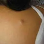 Себорея тіла і її лікування як лікувати себорею на тілі