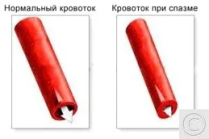 як лікувати спазм судин шиї
