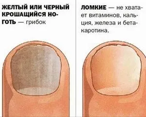 як лікувати деформований ніготь