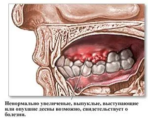 рак зуба симптоми