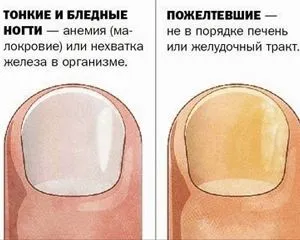 як лікувати деформований ніготь