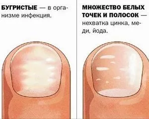 як лікувати деформований ніготь
