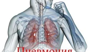 як лікувати хламідійну пневмонію