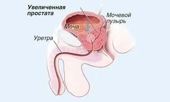 як лікувати діарею після променевої терапії