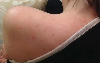 прищі на плечах види причини появи лікування профілактика