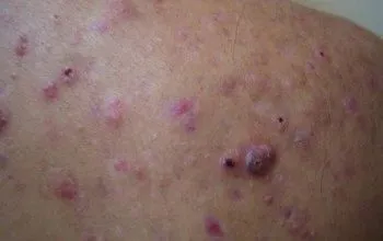 прищі на плечах види причини появи лікування профілактика