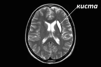 як лікувати кісту в голові у новонародженого