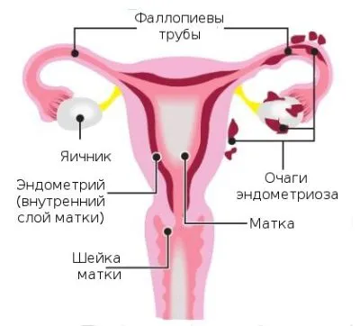 ендометріоз і ендометрит аденоміоз відмінності чим небезпечний чи можна вилікувати температура виділення