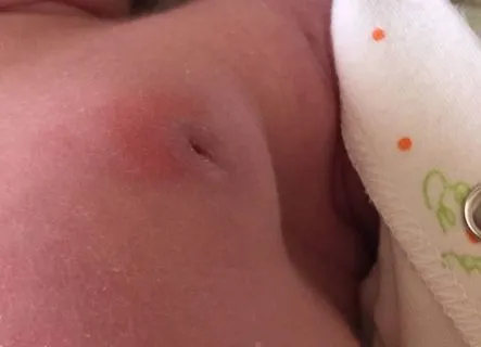 як лікувати дитячий мастит