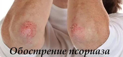 як лікувати загострення псоріазу