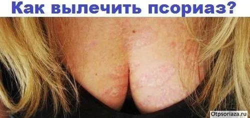 як лікувати псоріаз медикаментами