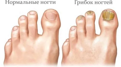 як вилікувати врослий ніготь паленим галуном