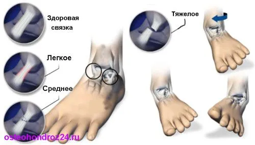 лікування розтягнення зв'язок гомілкостопу суглоба перша допомога