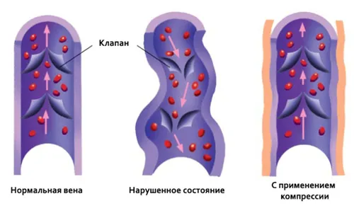 чи можна вилікувати варикоз бігом