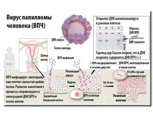 Причини появи папілом на інтимному місці як лікувати папіломи після пологів