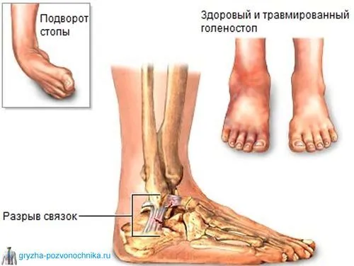 Розрив зв'язок розрив голосових зв'язок