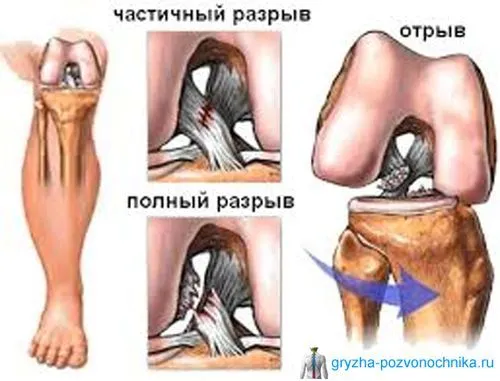 Розрив зв'язок частковий розрив зв'язок